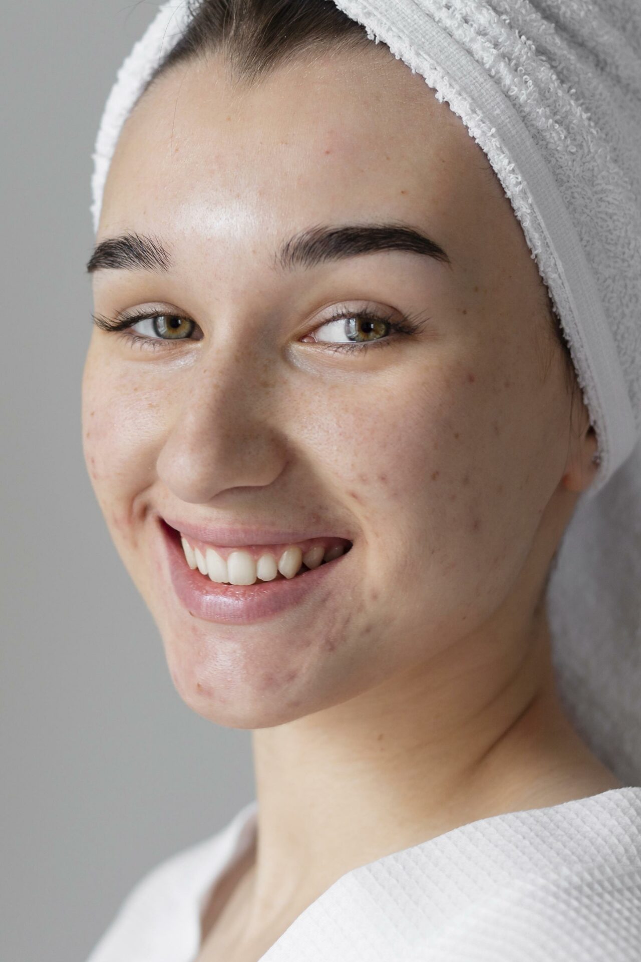 smiley-woman-with-acne-posing